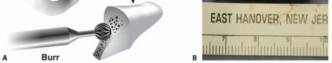 Illustration 22 for Glenoid Bone Graft for Anterior Shoulder Instability: Restore Stability