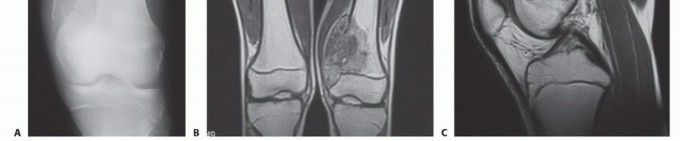 Illustration 17 for Precision Biopsy of Musculoskeletal Tumors for Accurate Diagnosis