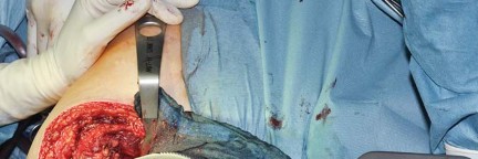 Illustration 43 for Collum Femoris Preserving: Achieve Better Primary Hip Outcomes