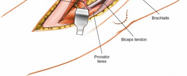 Illustration 60 for Mastering Elbow Approaches: Applied Surgical Anatomy for Precision