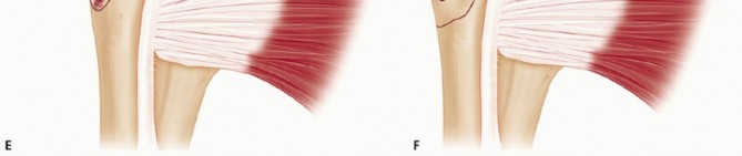 Illustration 12 for Optimizing Fixation of Proximal Humerus Fractures: A Guide