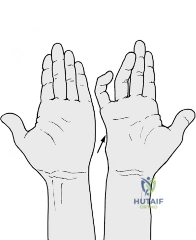 Dupuytren's: Preventing Damage to Your Distal Interphalangeal Joint
