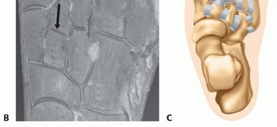 Illustration 2 for Fixation of Lisfranc Injuries: Essential Open Reduction Guide
