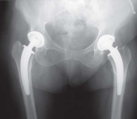 Illustration 80 for Collum Femoris Preserving: Achieve Better Primary Hip Outcomes