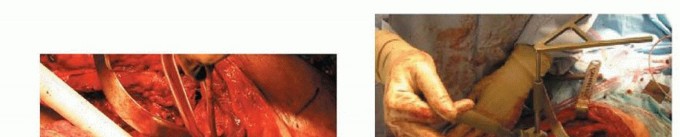 Illustration 9 for Hip Reimplantation Surgery: The Solution for Infected Implants