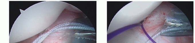 Illustration 6 for Finally Treat Recurrent Posterior Instability of the Shoulder