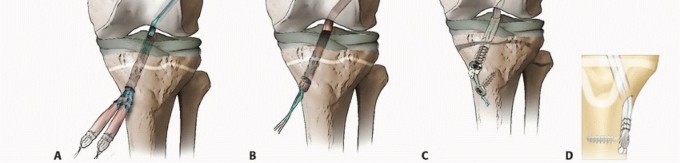 Illustration 24 for Preventing Growth Plate Risk: ACL Reconstruction Using Autogenous Grafts