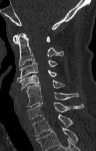 Illustration 2 for Why This Neck Injury Causes Hand Weakness: Central Cord Syndrome