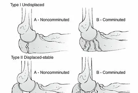 صورة توضيحية لـ كسور الزند المرفقي: دليل شامل للمرضى في اليمن والخليج العربي مع الأستاذ الدكتور محمد هطيف