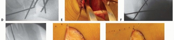 Illustration 15 for Calcaneal Lengthening Osteotomy: Correcting Hindfoot Valgus