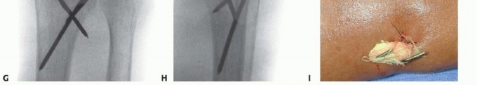 Illustration 18 for Effective K-Wire Fixation: Distal Radius Fractures Without External Fixation