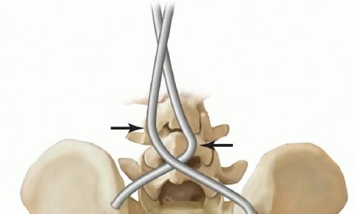 Illustration 22 for Duchenne Muscular Dystrophy: Is Spinal Fusion the Answer?
