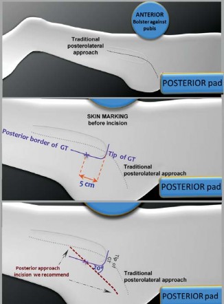 Illustration 24 for Birmingham Hip Resurfacing Designer's Technique for Active Lives