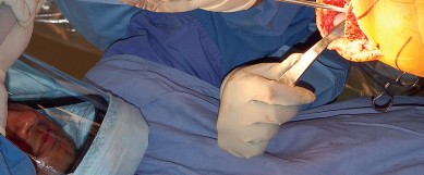 Illustration 24 for Mastering Gap Balancing in Revision TKA: Avoid Common Pitfalls