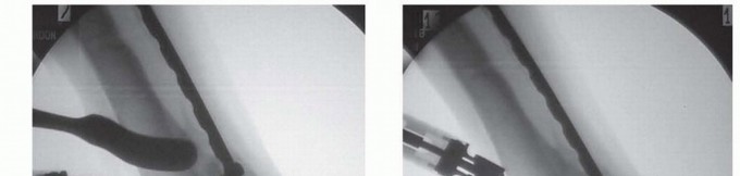 Illustration 6 for Distal Tibial Osteotomy: Fixing Varus & Valgus Ankle Alignment