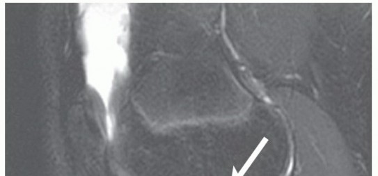 Illustration 3 for Preventing Growth Plate Risk: ACL Reconstruction Using Autogenous Grafts