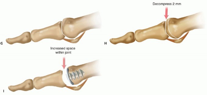 Illustration 26 for End Articular Cartilage Loss: Arthrosurface HemiCAP Resurfacing