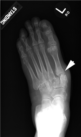 Illustration 43 for First Metatarsal Surgery: Expert Solutions for Foot & Ankle Pain