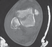 Illustration 26 for Talar Neck Fracture Treatment: Optimizing Recovery with ORIF