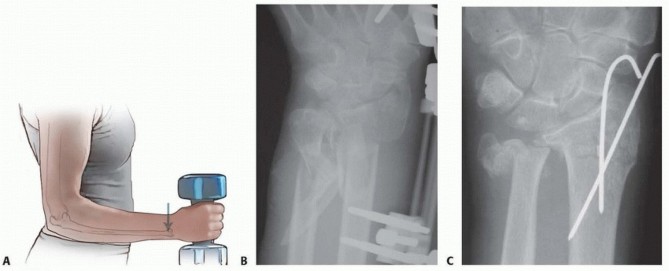 Unlocking Better Outcomes: Open Reduction for Distal Ulnar Fractures