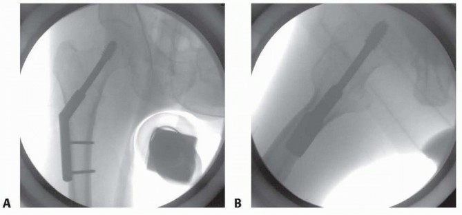 Illustration 29 for Is a Sliding Hip Screw Best for Your Femoral Neck Fracture?
