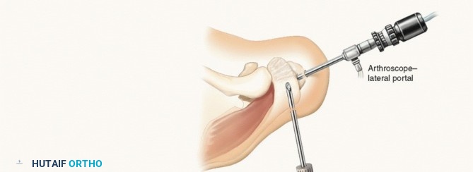 Illustration 11 for Find Relief: Arthroscopic Subacromial Decompression for Impingement