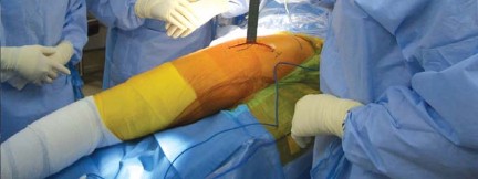 Illustration 48 for Successful Total Hip Replacement in Developmental Dysplasia