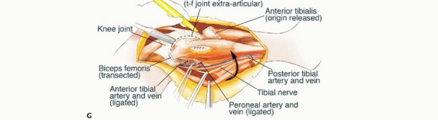 Illustration 23 for Beyond Amputation: The Type I Resection in Fibular Tumor Surgery