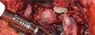 Illustration 51 for Management of Periprosthetic Fractures: An Expert Surgical Guide