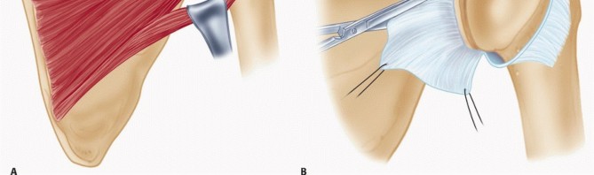 Illustration 16 for Mastering the Treatment of Recurrent Posterior Shoulder Instability