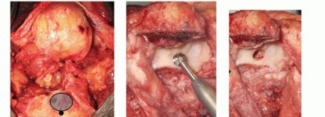 Illustration 24 for Distal Humeral Fractures: When Is Elbow Replacement the Best Option?