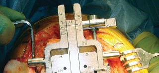 Illustration 34 for Mastering TKA: Essential Methods of Rotational Alignment