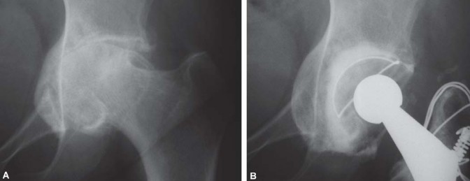 Illustration 30 for Expert Bone Grafting for Primary Total Hip Replacement Success