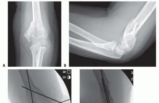 Effective Fixation of Pediatric T-Condylar Fractures for Best Outcomes