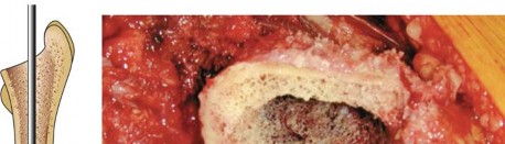 Illustration 21 for Mastering Cementing Technique Femur: A Step-by-Step Guide