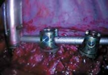 Illustration 25 for Mastering Anterior Interbody Arthrodesis with Instrumentation for Scoliosis