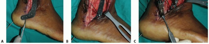 Unlock Stable Arthrodesis with Blade Plate Fixation