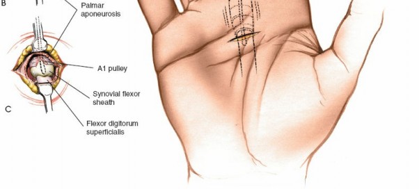 Illustration 215 for Essential Surgical Approaches: Uncover Every Aspect of the Wrist