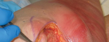 Illustration 5 for Minimally Invasive THA: Navigating Techniques, Benefits & Pitfalls