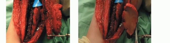 Illustration 28 for Free Vascularized Fibular Grafts: Solving Complex Bone Defects