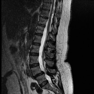 Illustration 28 for Adjacent Segment Degeneration: Your Next Spine Case Solved