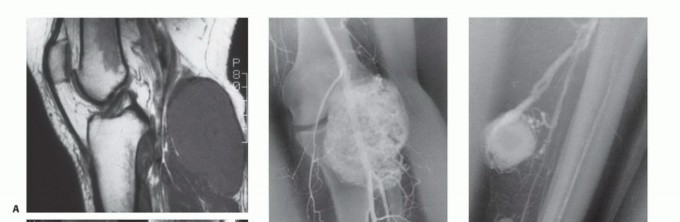 Illustration 8 for Precision Biopsy of Musculoskeletal Tumors for Accurate Diagnosis