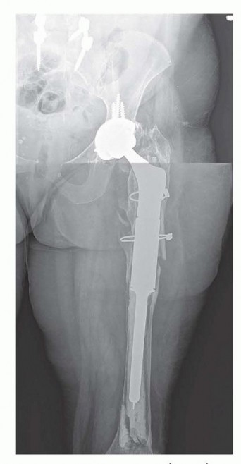 Illustration 4 for Limb Salvage: New Advances in Proximal Femoral Replacement