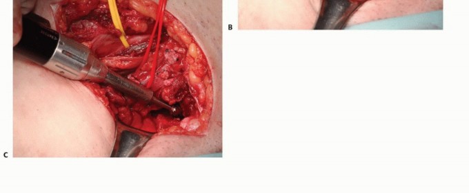 Illustration 37 for Pelvic Metastasis Surgery: A Component of the Utilitarian Approach