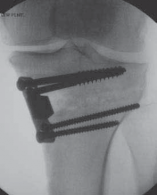 Illustration 43 for Guide Pin Assembly: Key to Flawless Upper Tibial Osteotomy