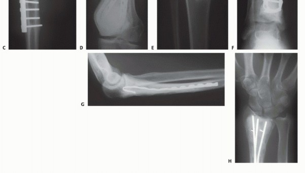 Illustration 12 for Avoid Major Surgery: Bone Tumor Treatment with Liquid Nitrogen Pour