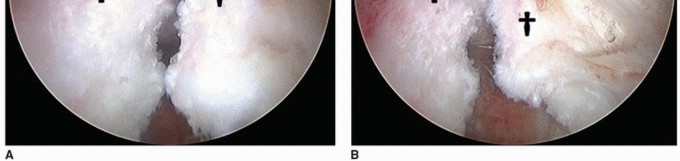Illustration 35 for Beyond Knee Surg: Hip Arthroscopy for Sports Injuries