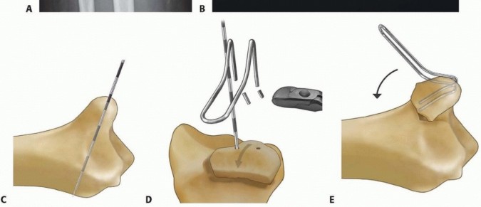 Illustration 27 for Fragment-Specific Fixation: Restore Carpal Facet Horizon