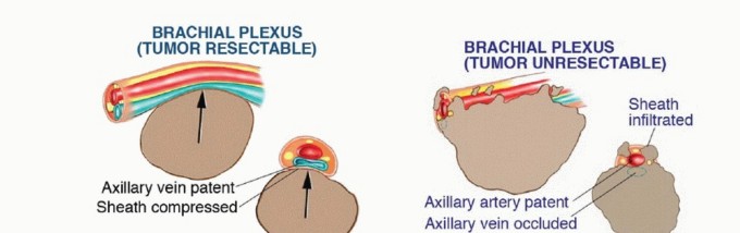 Illustration 9 for Axillary Space Exploration: Surgical Resection of Complex Tumors