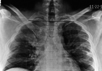 Illustration 47 for Right Shoulder Pain? Avoid This Common X-ray Mistake.